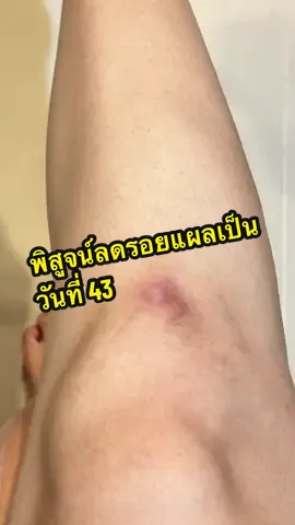 ดีจริงค่ะ ซื้อเถอะทำทุกวันขนาดนี้555 #เจลลดรอยสิว #พิสูจน์ลดรอยแผลเป็น #ลดรอยแผลเป็น #ลดรอยสิว