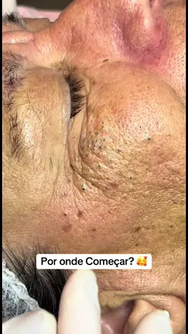 Comedões Abertos 😱 #viraltiktok #viral #cravos #cravosgigantes #cravossatisfatorios 