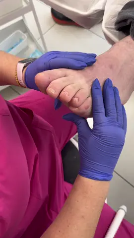 👣 Taloneți? 📞 Programează-te la 0742 212 268 sau direct pe site-ul nostru : www.dopodoheal.com #fyp#dopodoheal#pedichiuramedicala#bataturi#ciuperca            