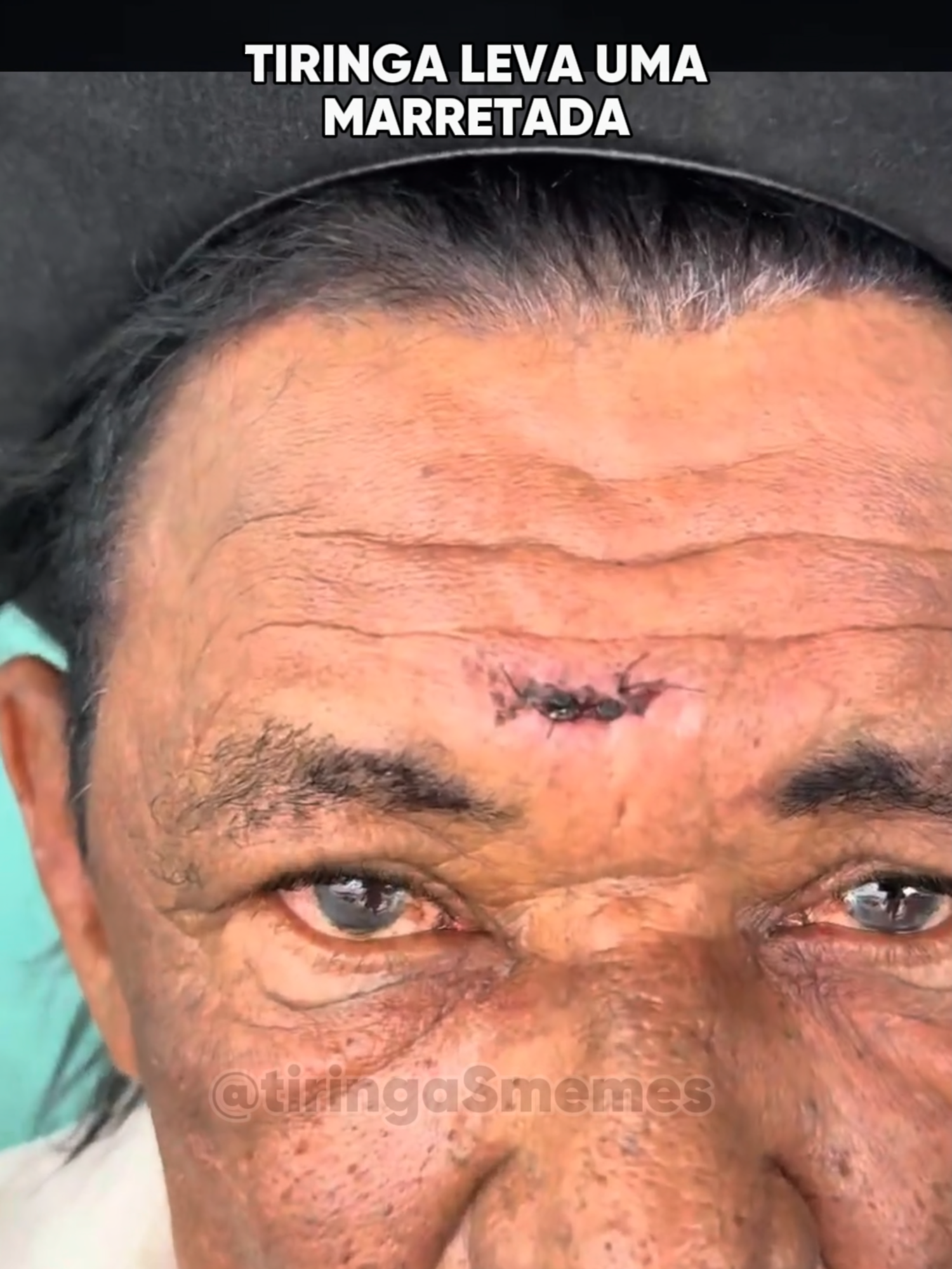 Charlles visita Tiringa após levar 6 pontos na testa kkkk  #tiringa #comediaselvagem #humor #comediahumor #comedia #meme #memes