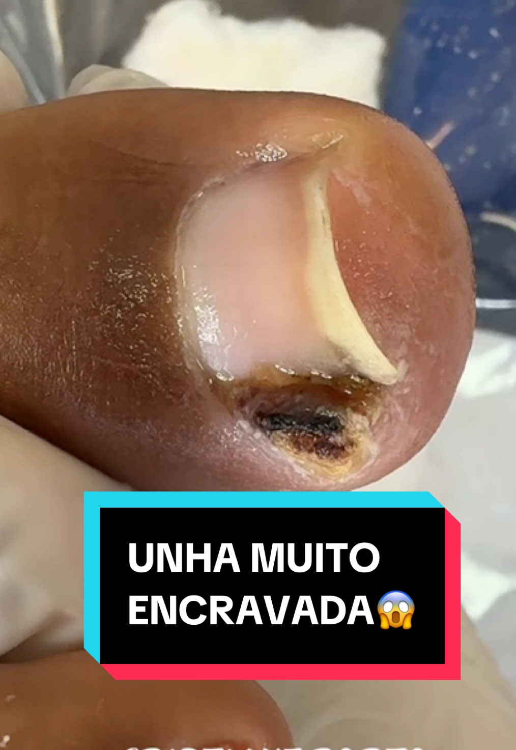 😱| UNHA MUITO ENCRAVADA . #podologia #satisfatório #unhas #fyp #unhaencravada  