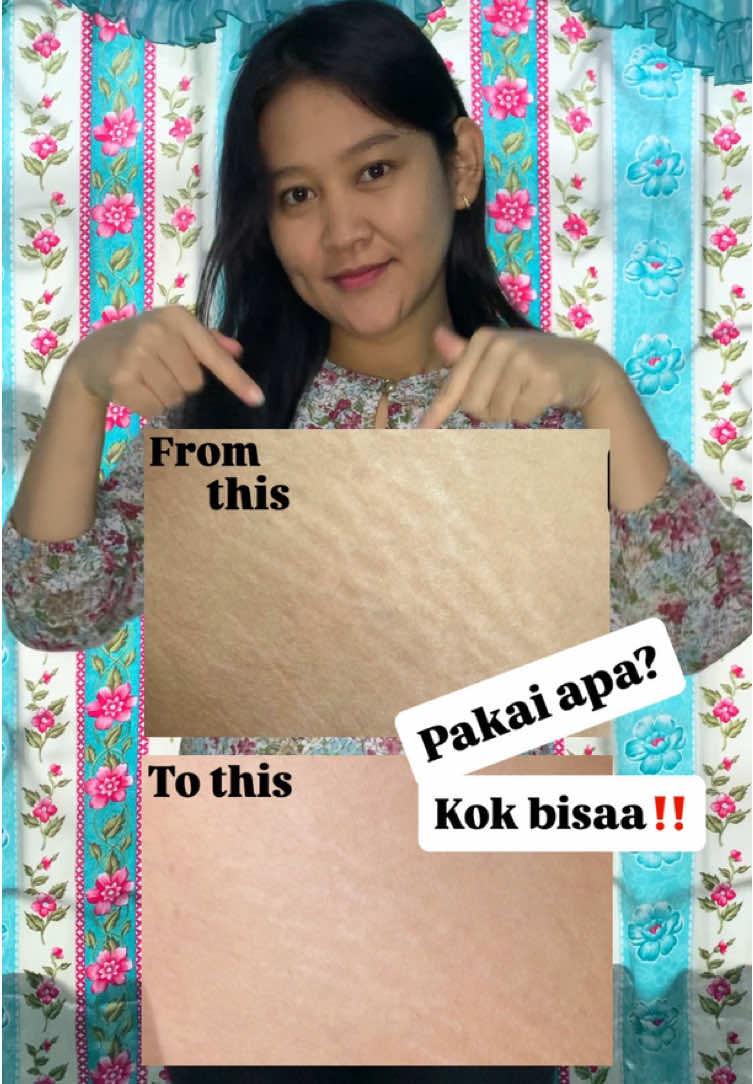 Produk mantulita untuk masalah stretchmark kamu😉 #ciaraindonesia #stretchmarkcream #stretchmark #ciara #fyppppppppppppppppppppppp 