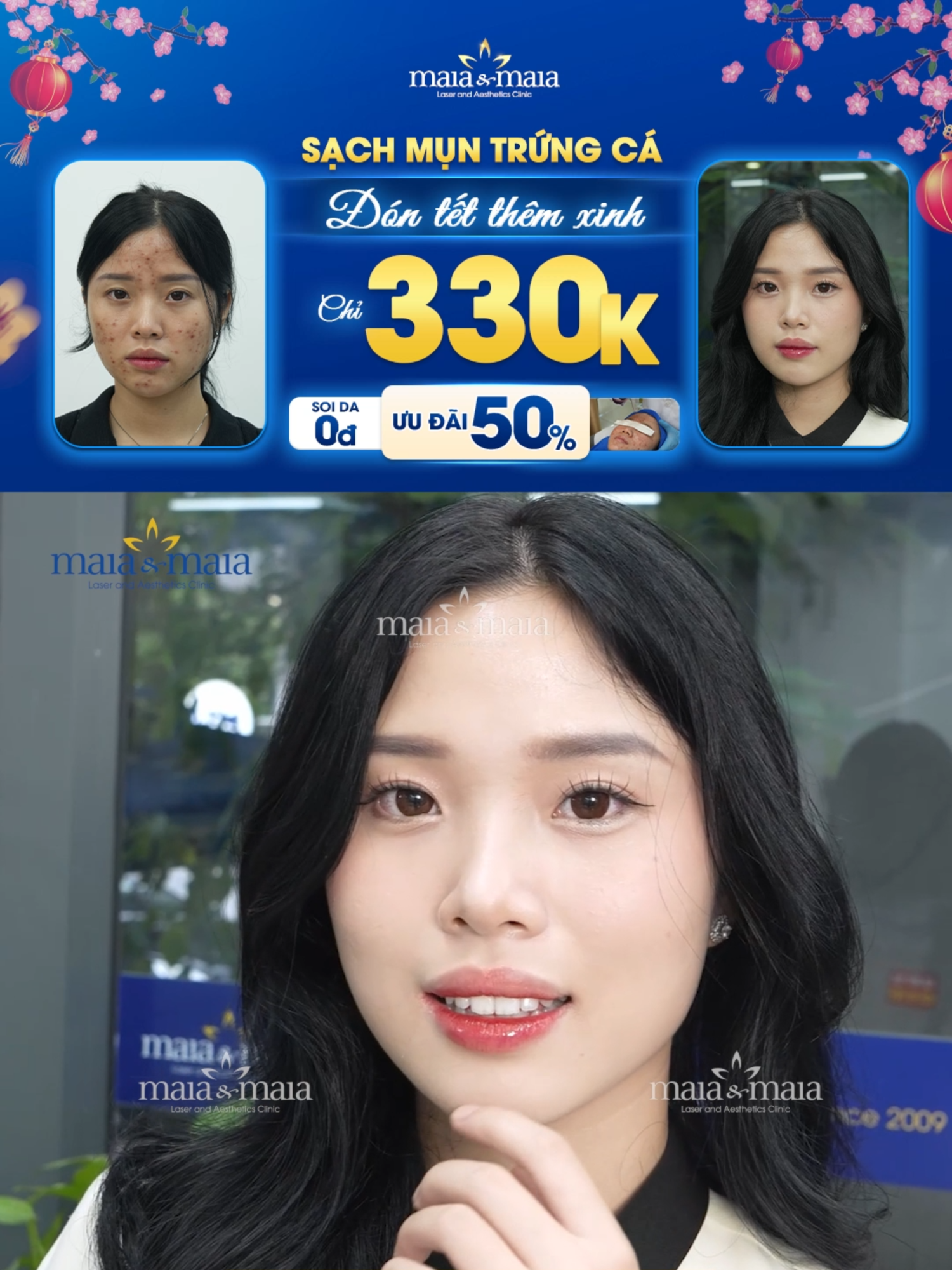 Trị mụn đón tết tặng ngay ưu đãi giảm 50% khi đặt lịch trước. Được trực tiếp bác sĩ thăm khám và lên phác đồ điều trị. Inbox đặt lịch ngay #fypp #xuhuong #viral #viralvideo #trending #phongkham #maia #trimunantoan #munan #muntrungca #seoro #dalieu