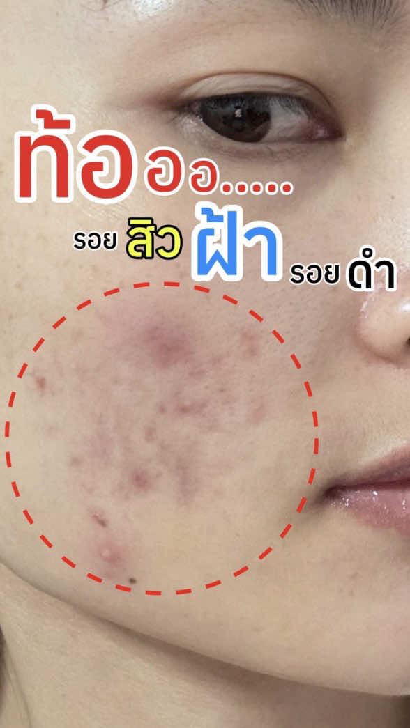 ปกปิดดี✅ คุมมัน✅ สบายผิว✅ เอาจริงคือเซ็ตนี้ใช้ดีขนาดนี้ ไม่กดจะอดใจไหวหรอ❗️ #ปิดรอยสิวฝ้ากระ #ปกปิดสวยเนียนเป็นธรรมชาติ #หน้านุ่มชุ่มชื่นไม่แห้งกร้าน #ล้างเครื่องสำอางสะอาด #เอบีน่าสวยช่วยทุกปัญหา 