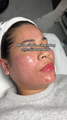 #meso_căng_bóng #meso_trắng_da #mesocấp_ẩm #meso_căng_bóng_trắng_sáng 