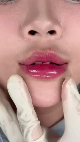 Siu phẩm môi baby chào ngày mới#filler #thuthuybeauty #fillermoi 