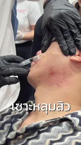 หลุมสิว 