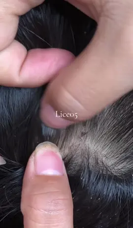 😱😱#omg #lice #liceremoval 