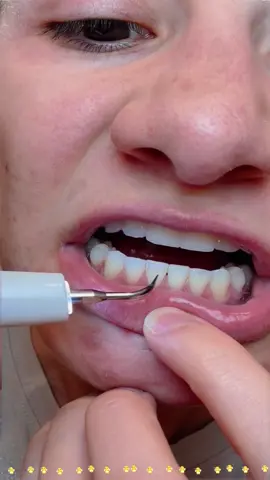 Fantastic teeth cleaning tools to solve your tartar troubles ！ #toothbrush #waterflosser #electrictoothbrush #tiktokshopblackfriday #tiktokshopcyberMonday