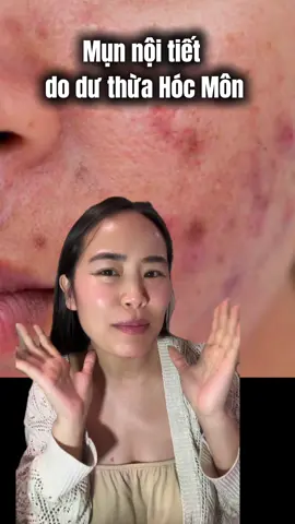 Mụn nội tiết do dư thừa Hóc Môn và những biểu hiện đi kèm #mụn_viêm#thaidoc #detox #mụn #mụnnoitiet 