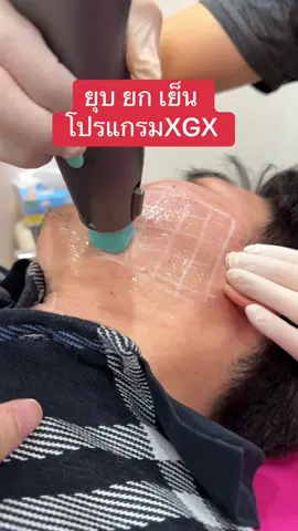 #เทรนด์วันนี้ ทำก่อนเดี๋ยวตกเทรน ยุบ ยก เย็น กับ โปรแกรม XGX  ทำครึ่งหน้าแก้มก็ยุบลง  #oligiox #ยกกระชับใบหน้า #สลายไขมัน #หมอเบนซ์pjclinic  @k.เบนซ์ PJ  @k.เบนซ์ PJ  @k.เบนซ์ PJ 