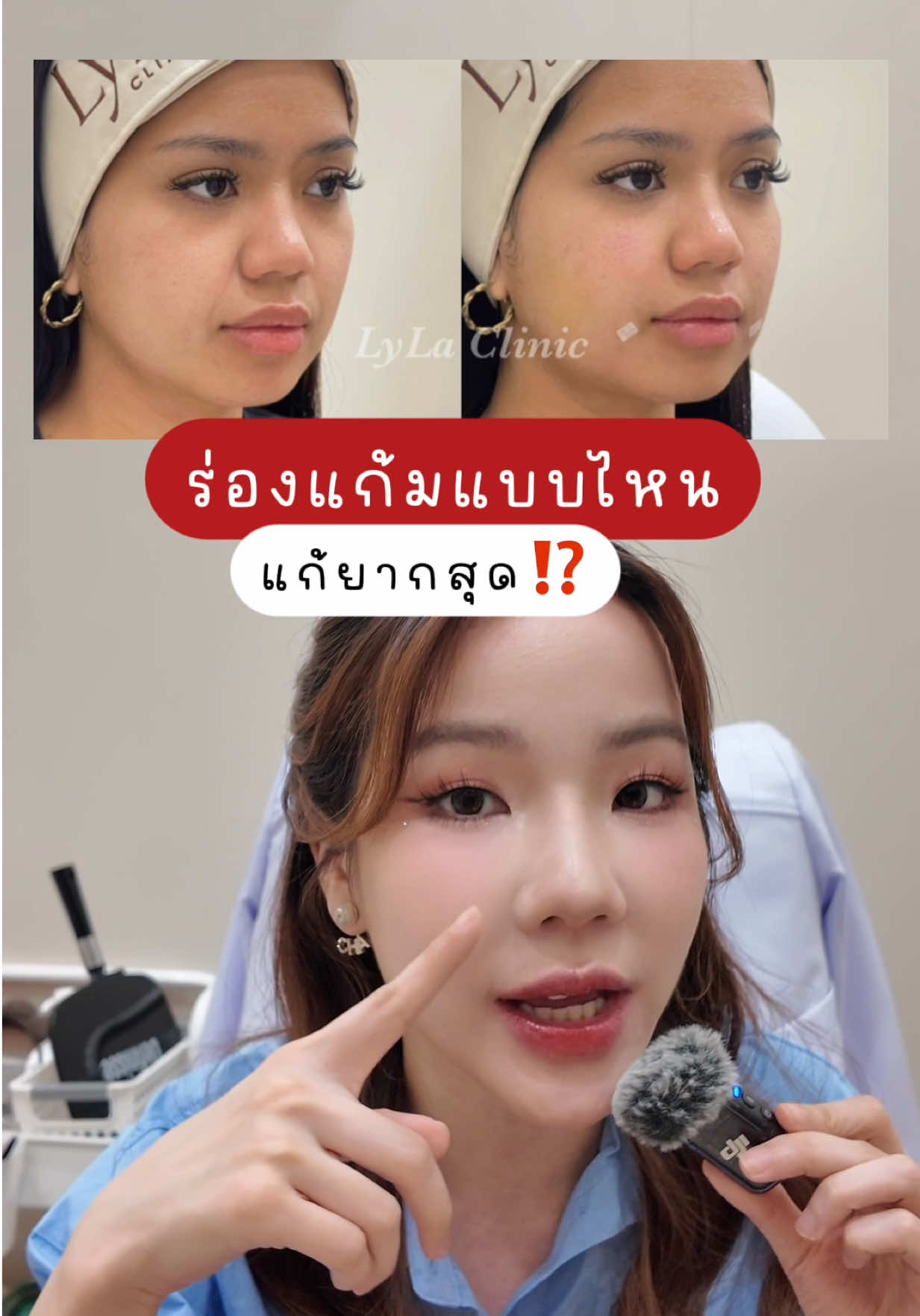 ใครมีร่องแก้มแบบไหนกันมั่งคะ🙋🏻‍♀️ #ร่องแก้ม #รีวิวบิวตี้ #เครื่องยกกระชับ #ฟิลเลอร์ 