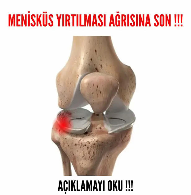 MENİSKÜS AĞRISINA SON! 🚫🔪 Ameliyatsız Çözüm: FİZİK TEDAVİ Gücü! Dizinizde aniden gelen o keskin ağrı, takılma veya kilitlenme hissi... Menisküs yırtığı yaşam kalitenizi düşürüyor olabilir. 😥 Büyük bir yırtık yoksa, çoğu menisküs problemi ameliyatsız tedavi ile düzelir! Ve bu tedavinin kalbi: Kişiye Özel Fizik Tedavi Programı! 👇 Ameliyat Etmeden Ağrıya Nasıl Son Verilir? Fizik tedavide amacımız, yırtık menisküsün üzerindeki yükü almaktır. Bunu şu 3 adımda başarıyoruz: 1️⃣ Stabiliteyi Sağla: Diz çevresindeki kasları (özellikle Kuadriseps ve Kalça Kaslarını) güçlendirerek, menisküsün şok emme görevini kaslar devralır. Güç = Koruma! 💪 2️⃣ Ağrıyı Dindir: Soğuk uygulama, TENS ve manuel terapi ile bölgedeki iltihap (ödem) ve ağrı kontrol altına alınır. 3️⃣ Esnekliği Geri Getir: Kilitlenmeden kaynaklanan sertliği gidermek için nazik ve kontrollü hareketlilik egzersizleri yapılır. Menisküs yırtığında fizik tedavinin başarısı, tamamen kas gücünü artırmaya odaklanmaktan geçer! Unutmayın: Dizinizdeki takılma/kilitlenme devam ediyorsa veya ağrı şiddetliyse doktorunuza başvurun. Ancak doktorunuz fizik tedavi önerdiyse, programa sonuna kadar sadık kalın. Bu diz sizin! Siz de menisküs sorunu yaşadıysanız, nasıl iyileştiğinizi yorumlarda paylaşın! 👇 #meniscus #menisküs #diz #ağrı #fiziktedavi 