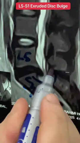#backpain #discbulge #discherniation #sciatica #spinesurgeon 