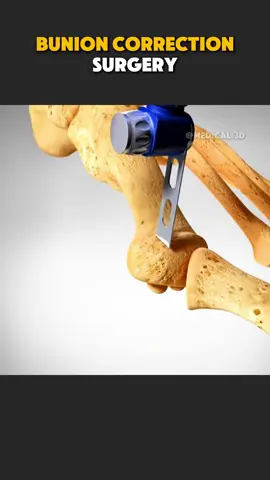 Bunion Correction Surgery | Bunion Osteotomy (3D Animation) #bunionectomy #bunionectomyprocedure #bunioncorrection #bunionsurgery #osteotomysurgery 