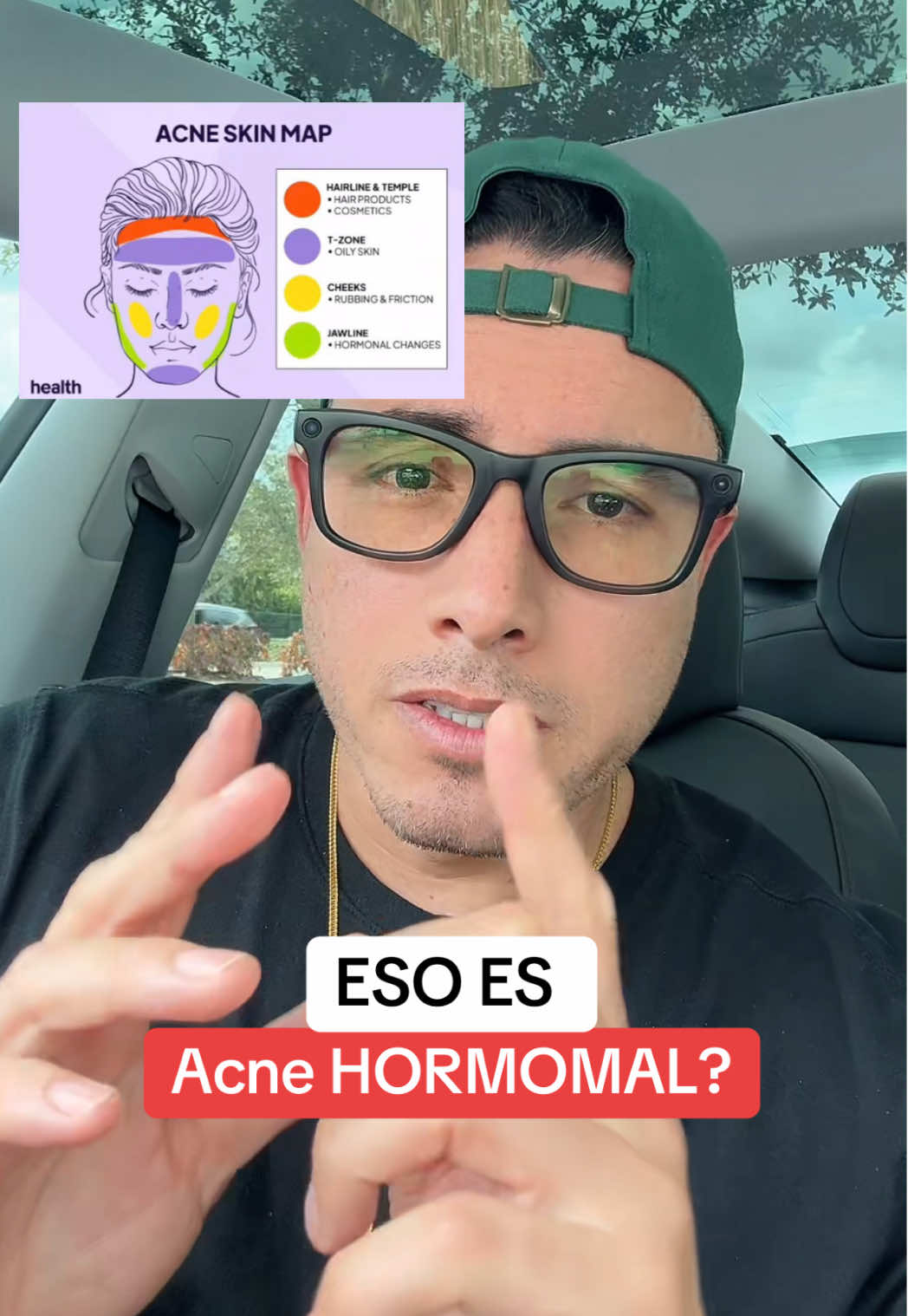 Que es el ACNÉ HORMONAL? #acnehormonal #dim #skin #tiktokshopblackfriday #bfcm @NelloSuperCalmOficial @CLEARSTEM Skincare 