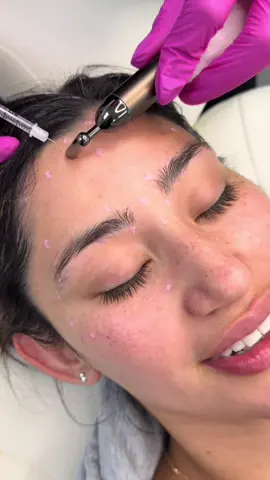 Let’s sprinkle some magic✨💖 . . Licensed cosmetic doctor.  Educational, non-graphic content. . . #cosmeticclinictj #viralvideo #aestheticmedicine #education #skincare 