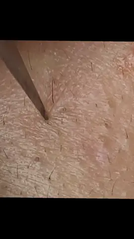 #deepcleaning #SkincareASMR #PimplePopping #BlackheadRemoval #SatisfyingVideo 