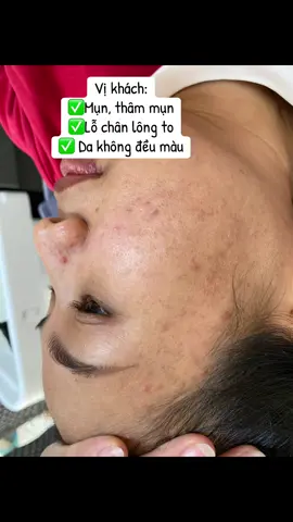 Peel da giúp ✅Thay đi một lớp da mới ✅Giảm mụn rõ rệt  ✅ Trắng sáng - Căng bóng #daotaohocvien #điều_trị_mụn_nám_rỗ_tàn_nhang #trắngda #peelda #xuhuong 