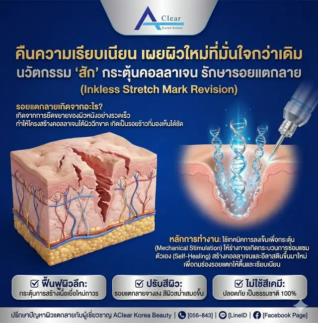 💙✨ รอยแตกลาย…สามารถฟื้นฟูได้จริง ไม่ใช่แค่ความหวัง นวัตกรรม “สักกระตุ้นคอลลาเจน ไม่ใช้สีเคมี” ช่วยฟื้นผิวลึก กระตุ้นคอลลาเจนใหม่ ปรับสีผิวให้เรียบเนียนขึ้นอย่างเป็นธรรมชาติ ✔ ไม่ใช้สี → ปลอดภัย 100% ✔ ผิวแพ้ง่ายทำได้ ✔ ผลลัพธ์ค่อย ๆ ชัดขึ้นจริง ✔ ช่วยให้กล้ากลับมาใส่ชุดที่มั่นใจอีกครั้ง ✨ #สักกระตุ้นคอลลาเจน #รักษารอยแตกลาย #InklessStretchMark #ฟื้นฟูผิวลึก #ผิวเนียน 