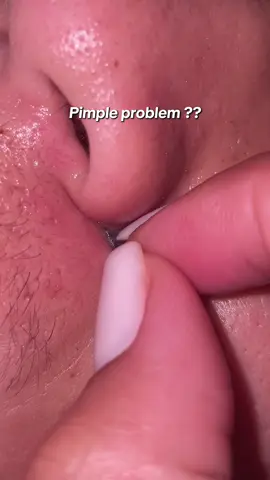 Patches for your unwanted pimples 💯😍🥰 #pimple #pimpleremover #pimplepatch #pimplepatches #fyp 