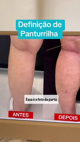 Não é só uma panturrilha… É sobre recuperar confiança, desenhar curvas e devolver leveza aos movimentos. Resultado de técnica + tecnologia + planejamento personalizado. #lipedema #lipedemabrasil #lipedemafighter #lipoescultura #lipedemalegs 