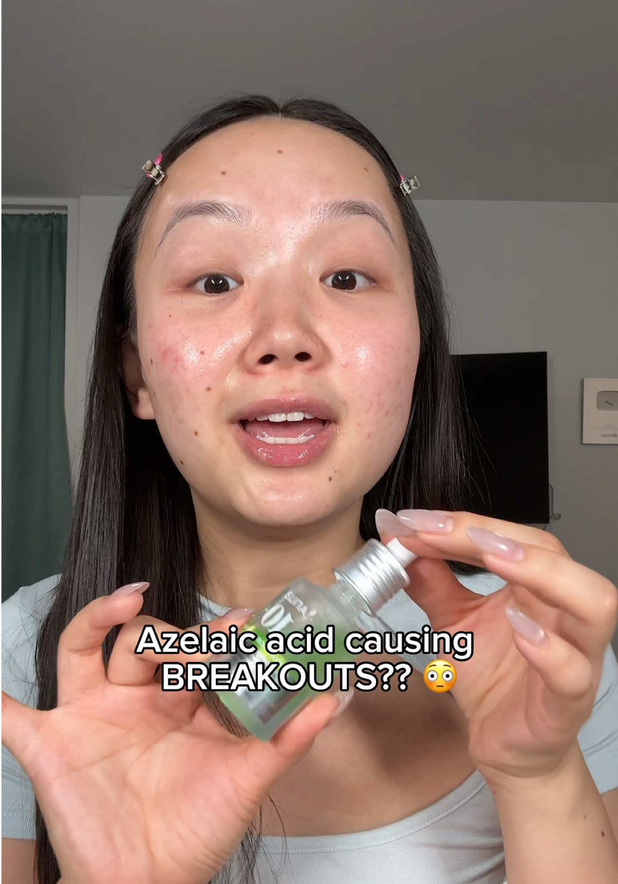 This combo changed everything for my acne prone skin 🤭🩵  @IUNIK US  #iunik #iunikbetaglucan #azelaicacid #acne #skincare 