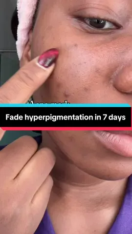 My first advice to anyone trying to fade hyperpigmentation is to always make sure you have a barrier repair moisturizer, which is why i always reach for this cream because it repairs the barrier and still fades dark spots. Gives value for the money spent . #koreanskincare #darkspots #hyperpigmentation #acnescar #skincaretips
