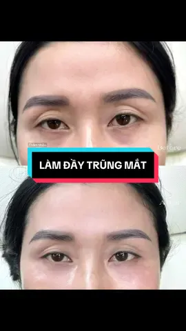 ✨ 𝐓𝐫𝐢̣ 𝐭𝐡𝐚̂𝐦 , 𝐥𝐚̀𝐦 𝐝𝐚̂̀𝐲 𝐭𝐫𝐮̃𝐧𝐠 𝐦𝐚̆́𝐭 👁️  Trũng mắt sâu, tối màu tạo cảm giác mệt mỏi và thiếu sức sống thì chị em nên chọn dịch vụ tiêm làm đầy và trị thâm . để gương mặt trở nên thu hút, tự tin hơn nha 💖 #tienleacadamy #TienLeAcademy #HAdaytrungmat 