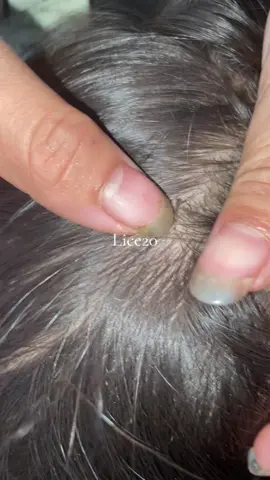 Lice😱#omg #lice #liceremoval 