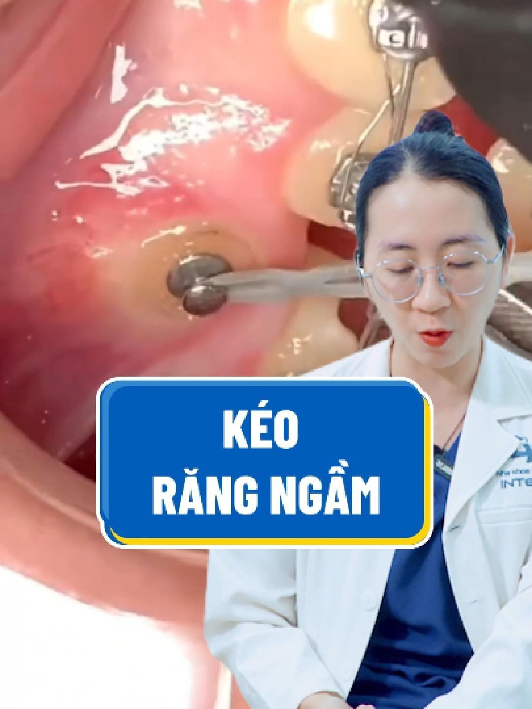 Cận cảnh kéo răng ngầm #niengrang #niengranglacvietintech #lacvietintech #keorangngam #rangngam