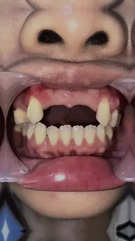 Pasang gigi palsu jenis acrilik😍 pm 0168569348 #masyusril #ahligigi #gigipalsu #gigiacrilik #tkimalaysia🇲🇾🇮🇩 #CapCut 