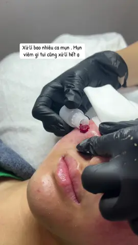 Lyn spa 30 Nguyễn Đức Cảnh #lấynhanmunchuanykhoa #pelldasinhhoc #buônmathuột 