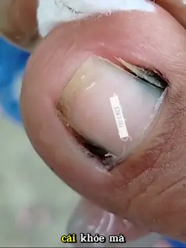 Lấy khoé siêu phê #laykhoe #laykhoemong #laykhoechan #laykhoemongchan #taovamich 