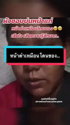 #ครีมปราบฝ้า ครีมหน้าใส #ฝ้ากระจุดด่างดํา #ฝ้าหนาฝังลึก แนะนําตัวนี้เลยค่ะ #ครีมrcc #ของแท้ต้องมีบัตรตัวแทนเท่านั้น✓ 