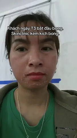 Ngày T3 đây ạ#ilaspa #DMPChauAu #chemicalpeel 