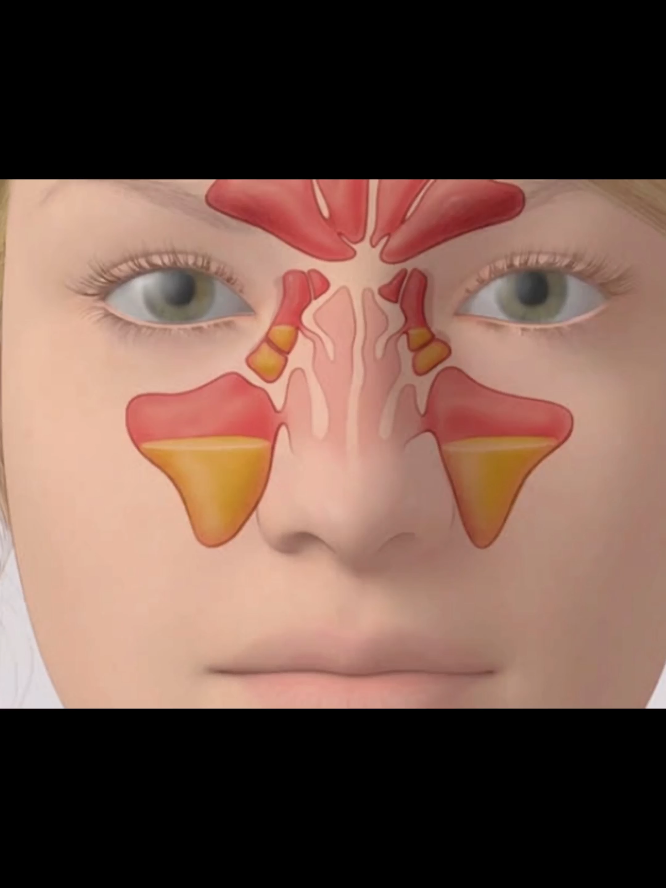 Sinus Inflammation – How Blocked Sinuses Cause Facial Pressure #Sinusitis #NasalHealth #MedicalAnimation #RespiratorySystem #HealthInfo