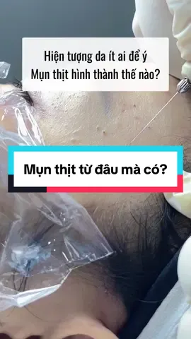 Hiện tượng da ít ai để ý: mụn thịt hình thành như thế nào? #chiasekienthuc #chamsocda #munthit #lamdep #spa 