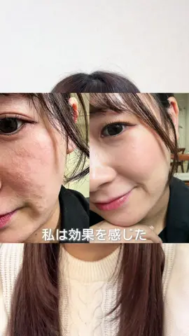 本気で肌を変えたい方『スキンケア』とコメントください😊🤍 ✎┈┈┈┈┈┈┈┈┈┈┈┈ 数ヶ月前の私はアトピーでお肌ボロボロ スキンケア頑張っても1時間後には皮むけ ニキビもできるし最悪、、、 でもこの長年悩んだのって肌のバリアが弱ってるだけだった 肌を守る力を育てるケアに変えたら みるみる肌は変わって ノーファンデでお出かけしたり 夜までツヤ肌でいられるようになりました 一緒に自信の持てる肌作りませんか？ 本気の方限定でシェアしてます 『スキンケア』とコメントしてね☺️‎🤍 お肌でお悩みの方の力にきっとなれるはずです ✎┈┈┈┈┈┈┈┈┈┈┈┈ 見てくれてありがとう🫶🏻 なにを使っても改善しない アトピー歴＝年齢だった私が ホームケアのみ 最強のスキンケアメソッドに出会い 数ヶ月で改善、ツヤ肌になりました✨️ 私の人生が180°変わったスキンケア🫧 本気の方のみシェアしてます🎀 一緒に美肌目指しましょ🪄︎︎🪞