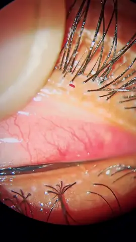 Comment your diagnosis & management ? #eye #ophthalmologist #optometrist #doctor #medicine 