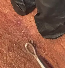 Wow #satisfying #extractions #viral #blackhead #fyp 