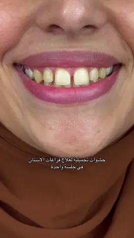 حشوات تجميلية لعلاج فراغات الاسنان فى جلسة واحدة بدون اى برد فى الاسنان .. #fyp #egypt #dentist #اسنان 