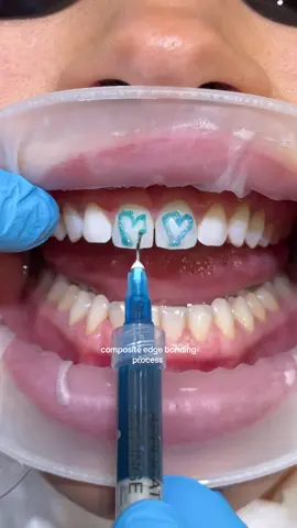 8 teeth composite edge bonding 🤍
