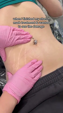 We are damaging the skin in order to provoke a healing response. The skin will always look worse before it looks better. This is our inkless treatment, we are using the treatment to fix the texture in this clients stretch marks 😊 Once healed this clients stretch marks will blend in more with their natural skin tone. #stretchmarkremoval #stretchmarks #stretchmarktreatment #paramedicaltattoo #enluvbeautylounge