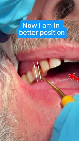 When we’re using traditional universal instruments, we must manually create the correct working angulation. That means adjusting the shank to about 70–80° off the long axis of the tooth in order to slide under the deposit and engage the cutting edge effectively. But with a Gracey, the design does the heavy lifting for you. Gracey curettes have an automatically offset blade, already built at the ideal 70–80° working angulation. That’s why your shank should stay parallel to the long axis of the tooth. When the shank is parallel, the blade naturally engages at the perfect angle for deposit removal. ✨ If adaptation or angulation is off (even slightly) your instrument won’t bite into the calculus, and removal becomes inefficient (or impossible). ✔️ Trust the design ✔️ Use parallel shank alignment ✔️ Let your Gracey do what it was made to do #DentalHygiene #RDH #DentalHygieneSchool #GraceyCurettes             #notaponsored thanks for @Zirc Dental Products for the mirror and @Young Innovations for the sharpen free double Gracey