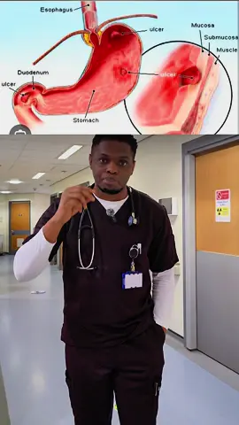 The treatment of peptic ulcer disease #ulcer #nigeria  #nigeriansinuk 