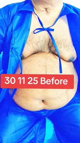 #viralvideos #tummytuck #foryoupage❤️❤️ #liposuction #2025 