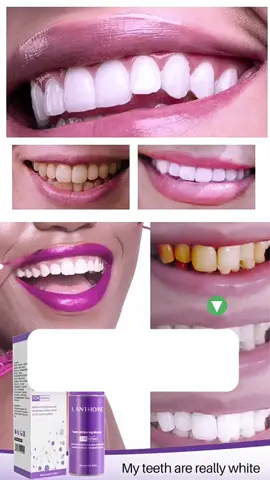 Dites adieu aux dents jaunes ⚡💜 #SourireBlanc #BlanchimentDentaire #LanThomeV34 #DentsBlanches #Sourire2025