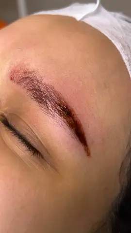 كذا الازاله ولا بلاش 🥰☺️👌🏻💯               #ازالة #ازالة_تاتو #tattooremoval  