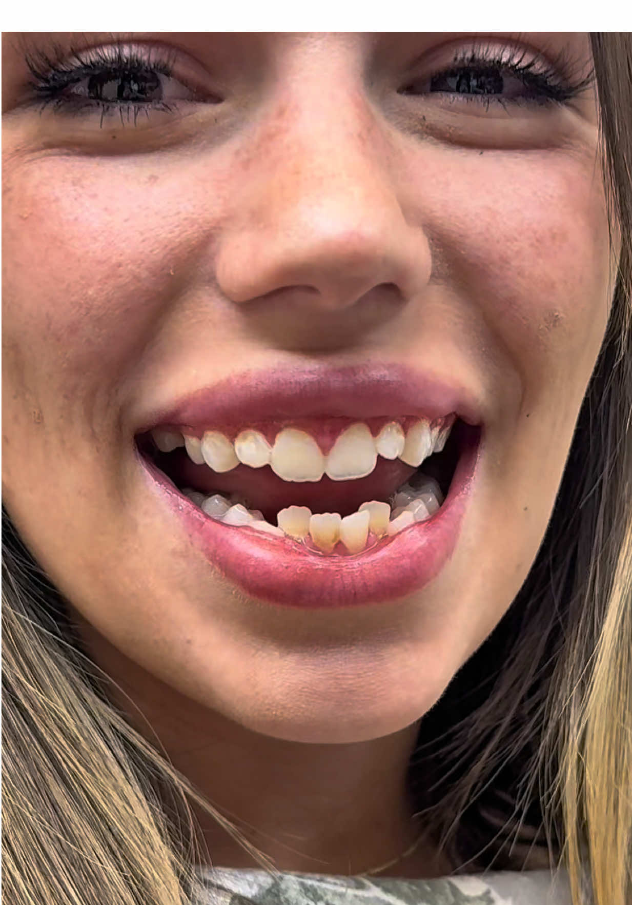 Crazy what can happen in 24 hours when you stop waiting for the ‘perfect time’ and finally choose yourself.  The only thing standing between where you are and where you want to be… is the decision to start.  #makeover #lifechanging #dentistry #drkennysmiles 